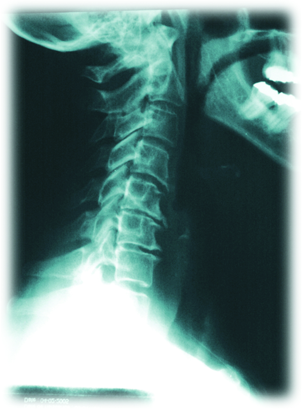 Focus sur la région cervicale montrant une gêne au cou, évoquant des tensions musculaires ou articul